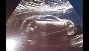 ਗਰਭਵਤੀ ਪਤਨੀ ਦੇ ਗਰਬ ਵਿਚ ਬੱਚੇ ਦੀ ਜਗ੍ਹਾ ਦਿਸੀ ਸਪੋਰਟਸ ਕਾਰ। 