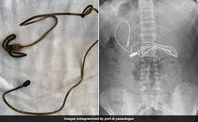 ਤੁਰਕੀ ''ਚ ਡਾਕਟਰਾਂ ਨੇ 15 ਸਾਲ ਦੇ ਮੁੰਡੇ ਦੇ ਢਿੱਡ ਵਿਚੋਂ ਕੱਢਿਆ ਕੁੱਜ ਅਜਿਹਾ ਕਿ ਉੱਡੇ ਹੋਸ਼। 